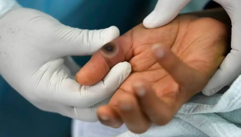 mpox 'not under control' health watchdog reports 'rising' cases 20241116 200459 0000