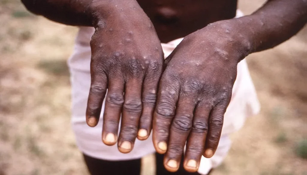 Kenya Mpox